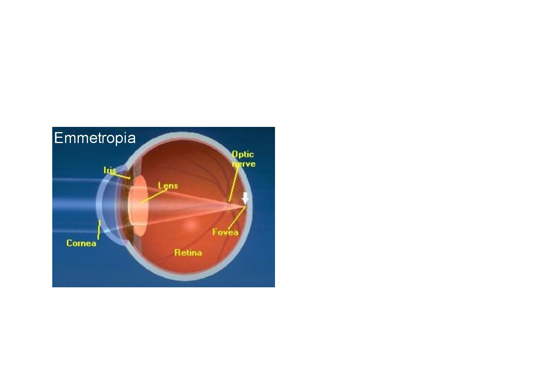 Emmetropia - clear vision