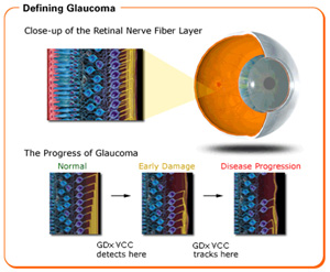 glaucoma-appearance of the retinal nerve fiber layer in glaucoma