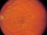 macular degeneration