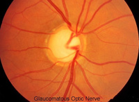 Optic Nerve showing glaucomatous optic nerve atrophy and optic nerve damage