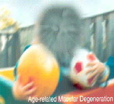 Age-Related Macular Degeneration