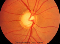 Glaucoma as it appears in the Optic Nerve