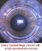 Intacts Corneal Rings viewed with a high powered microscope