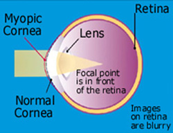 Eye problems - Myopia (nearsighted) causes blurred vision