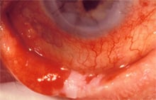 adenoviral conjunctivitis