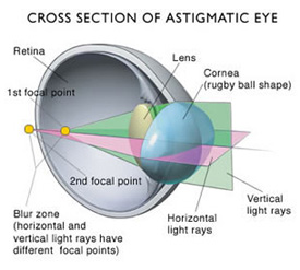 Astigmatism eye problem diagram