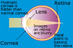 eye problem hyperopia (farsighted) causes blurred vision