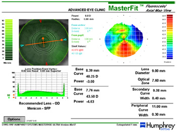 Computerized cornea analysis for Contact Lens Design