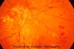 Retina photo of diabetic retinopathy.