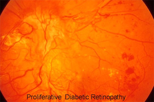 Retina photo of diabetic retinopathy.