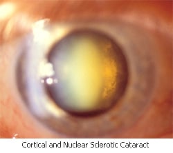 cataract, cortical cataract, nuclear sclerosis, clouding of the crystalline lens of the eye