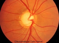 glaucoma, glaucoma medicine, glaucoma treatment, eye medicine, Zioptan