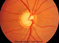 Optic Nerve showing glaucomatous optic nerve atrophy and optic nerve damage