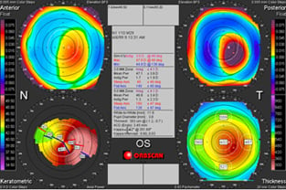 Report showing Keratoconus of the cornea-eye problem-eye disease