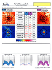 Glaucoma test report showing loss of retinal nerve fiber layer and early glaucoma diagnosis