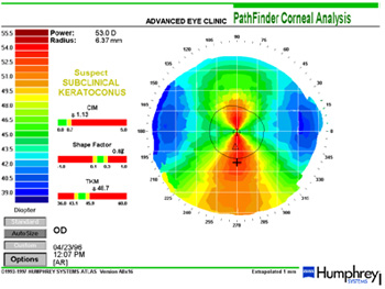 Eye problems - Keratoconus of cornea Report showing Keratoconus