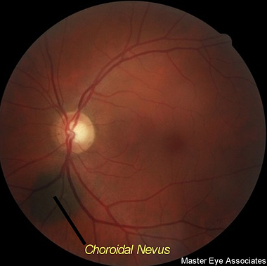 Choroidal nevus retina pigment not melanoma Master Eye Associates Austin