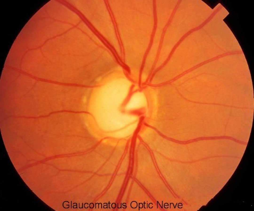 Glaucoma