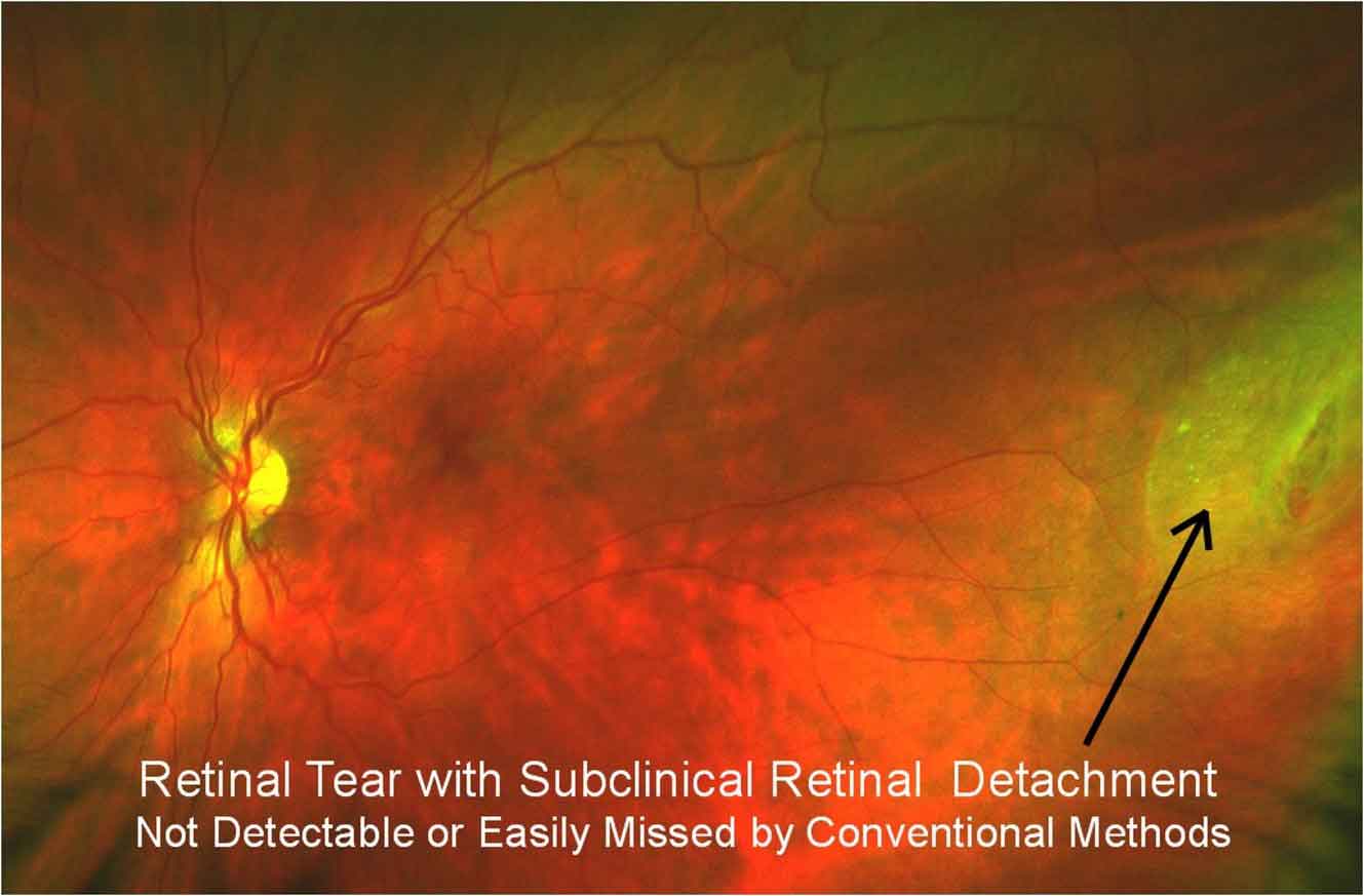 retinal tear