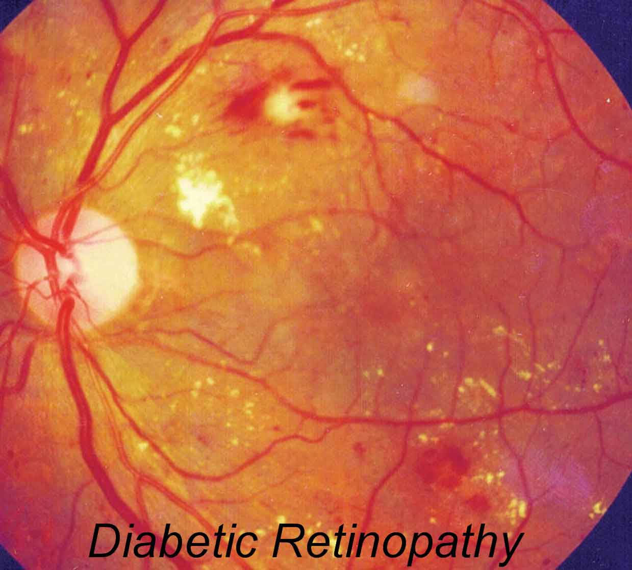 diabetic retinopathy