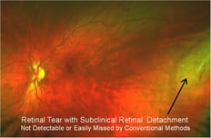 Retinal Tear with subclinical retinal detachment for Master Eye Doctors Austin Round Rockhighres