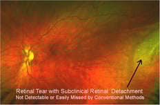 Retinal Tear with subclinical retinal detachment for Master Eye Doctors Austin Round Rockhighres