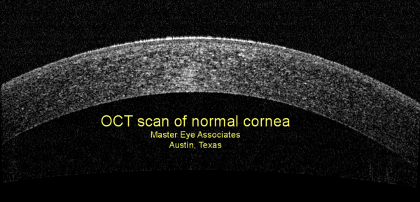 OCT_scan_of_normal_cornea_Master_Eye_Associates_Austin,_Texas_Dr._J._R._Lacey-resized-600