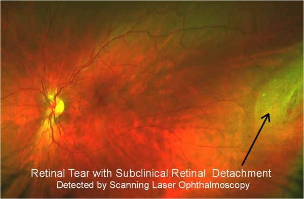 Retinal_Tear_with_subclinical_retinal_detachment_Master_Eye_Doctors_Austin_Round_Rock-resized-600