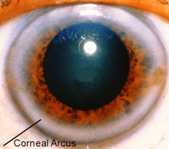 corneal_arcus_eye_photo-resized-600
