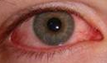 Herpes keratitis showing red eyes but no dendritic ulcer or fluorescein stain eye doctor in Austin resized 600 Herpes keratitis showing red eyes but no dendritic ulcer or fluorescein stain eye doctor in Austin resized 600